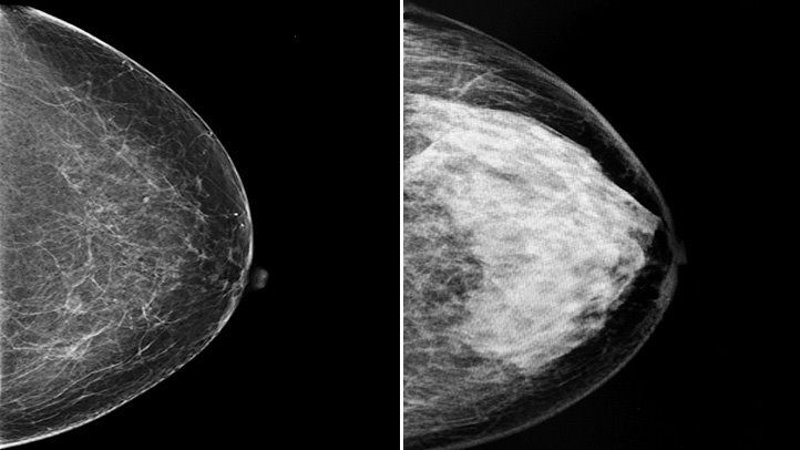 乳房x光片显示致密乳房和非致密乳房