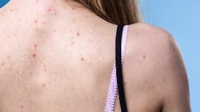 Back Acne (‘Bacne’) 101: Why Pimples Pop up, and How to Prevent and Get Rid of Them