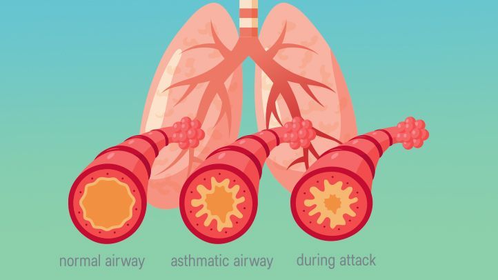 normal, asthmatic, and asthma attack airways