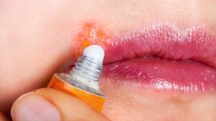 10 Cold Sore FAQs, Answered