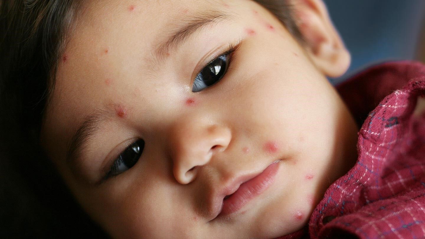 一个孩子用水痘