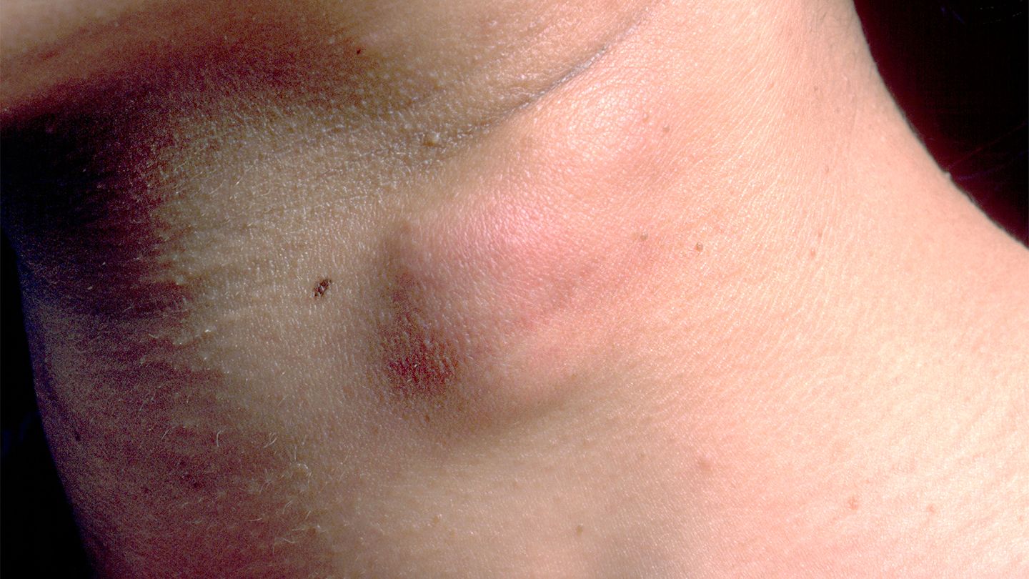 enlarged lymph node